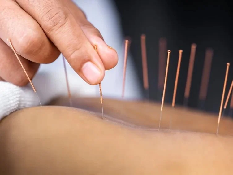 Up close shot of acupuncture therapy where the practioner is inserting a needle onto the patient's back