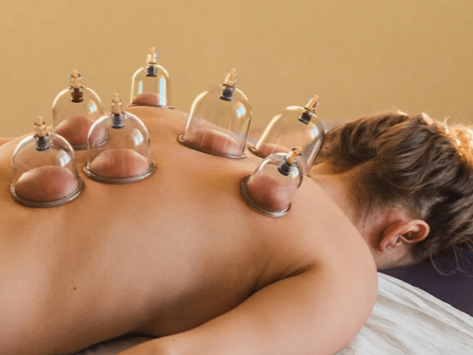 A photo demonstrating cupping therapy where a woman is lying face down on massage table with 7 plastic cups on her back.