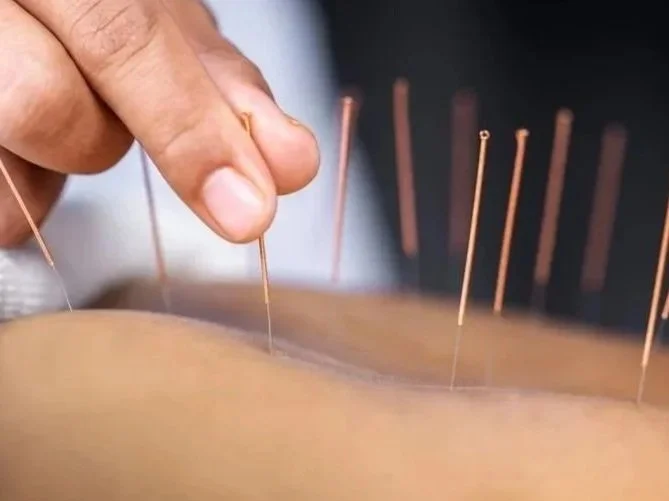 Up close shot of practitioner inserting needle into patient's back