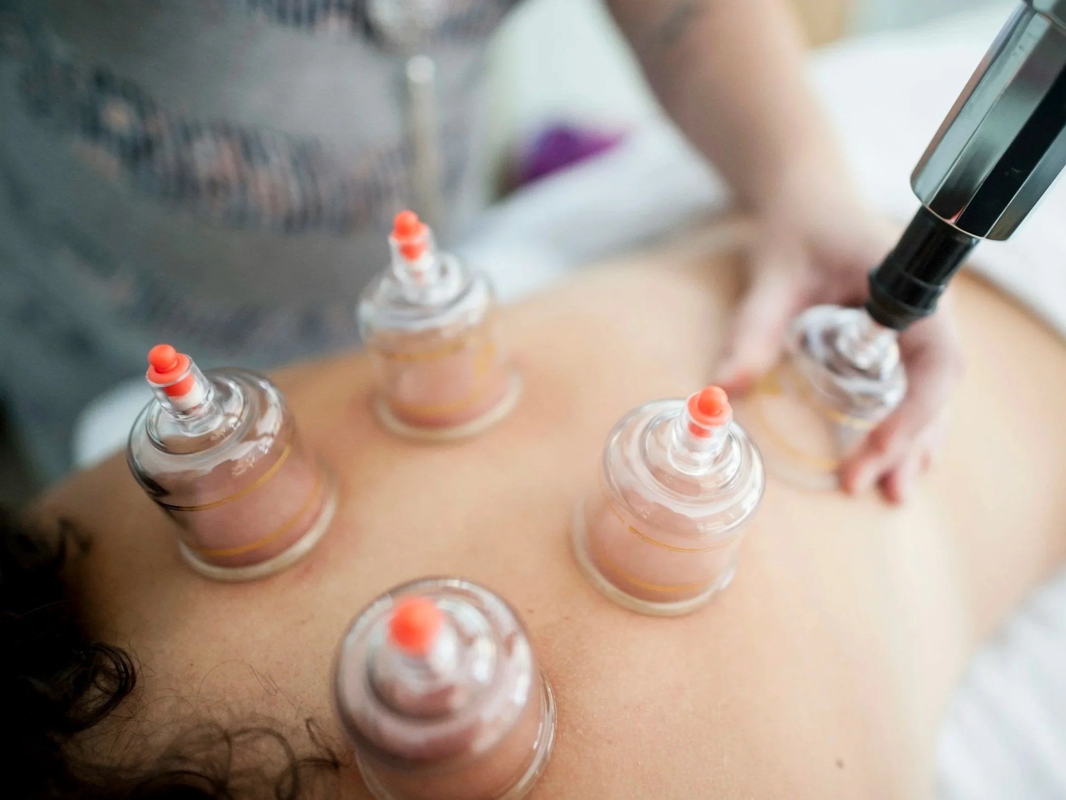 Practioner placing a 5th cup on a patient's back