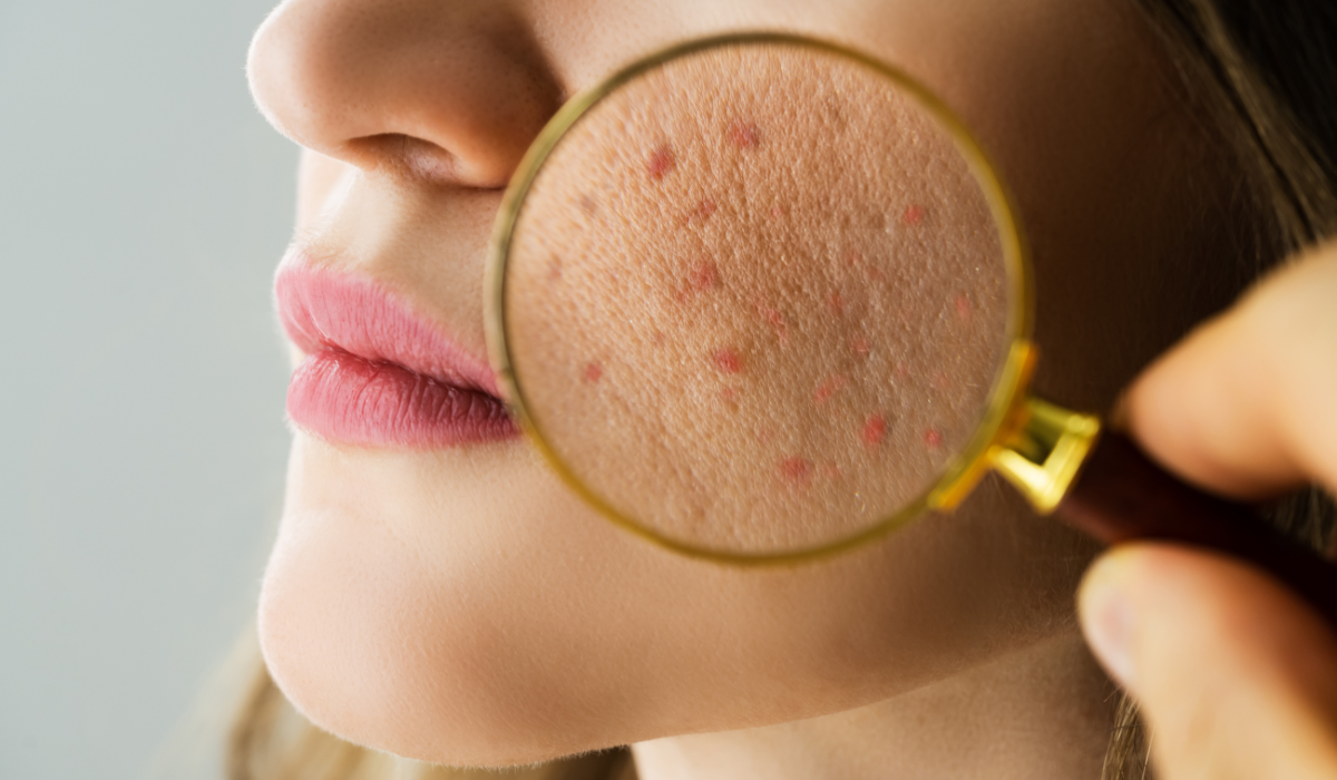 Medical acne peels Houston Chemical peel for acne Houston TX Non-steroidal acne treatment Houston Salicylic acid peel acne Medical grade chemical peel Houston