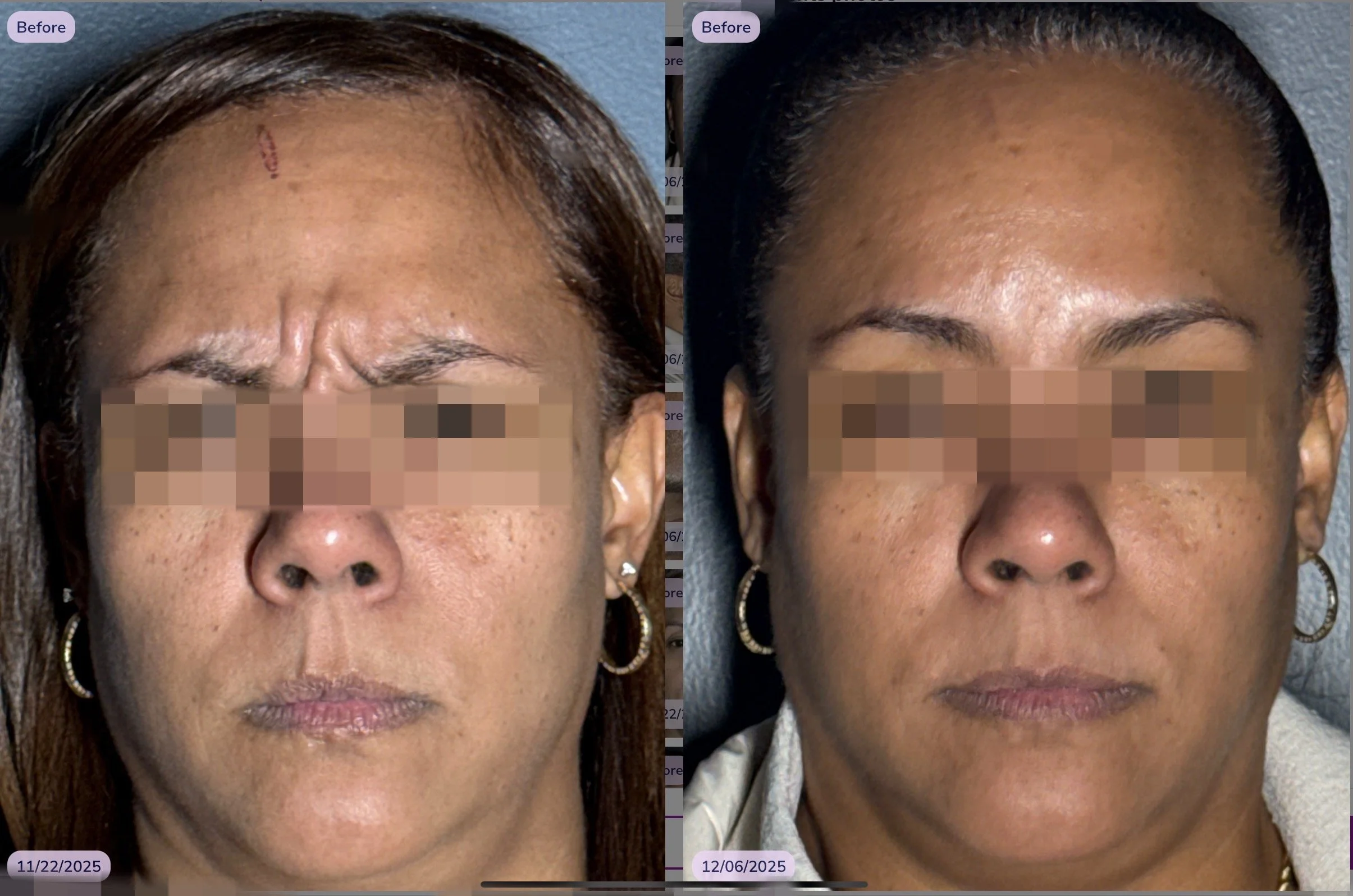 Deep Glabella, 11 frown lines.jpeg