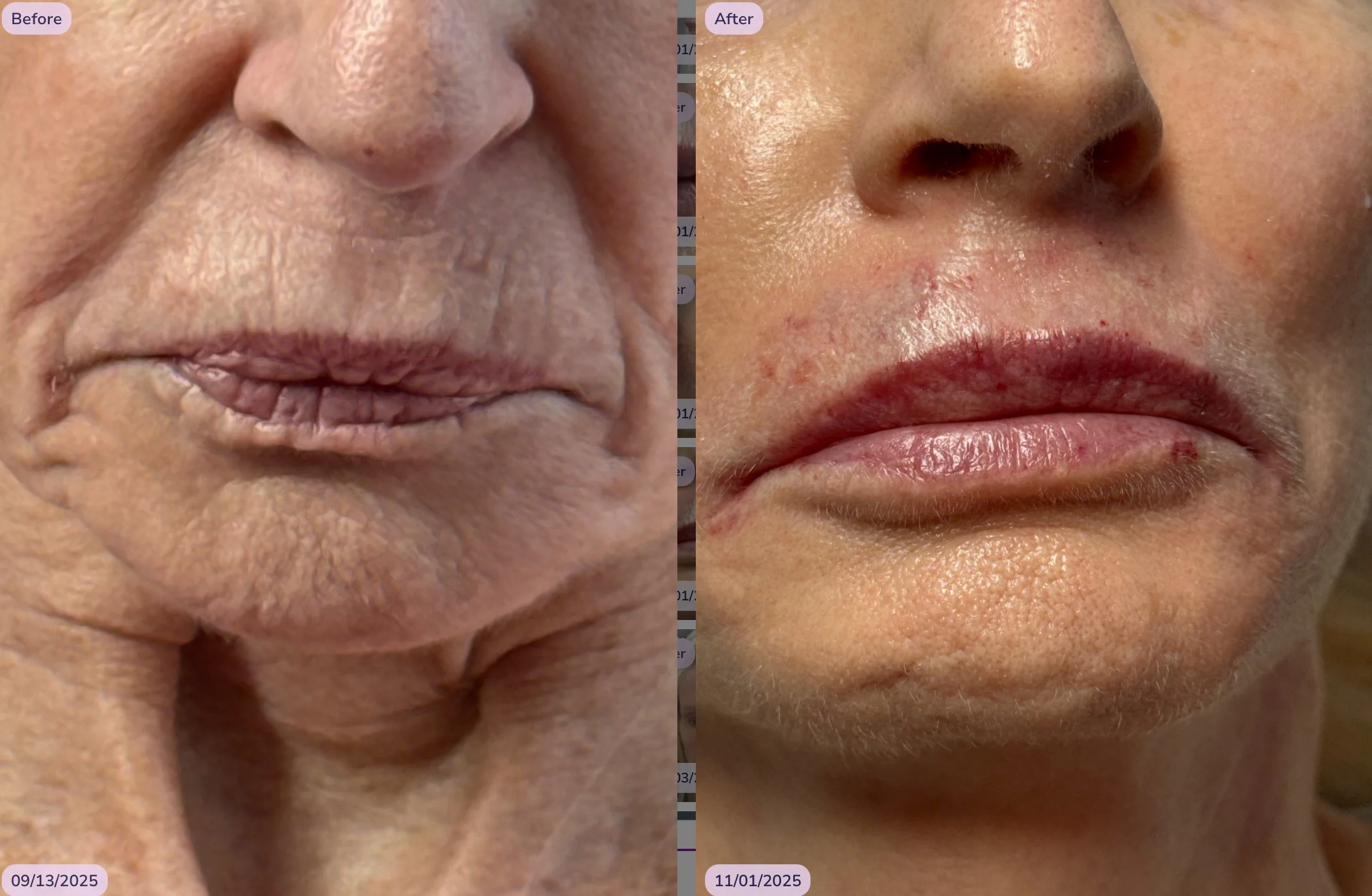 KB lips and smokers line filler .jpeg