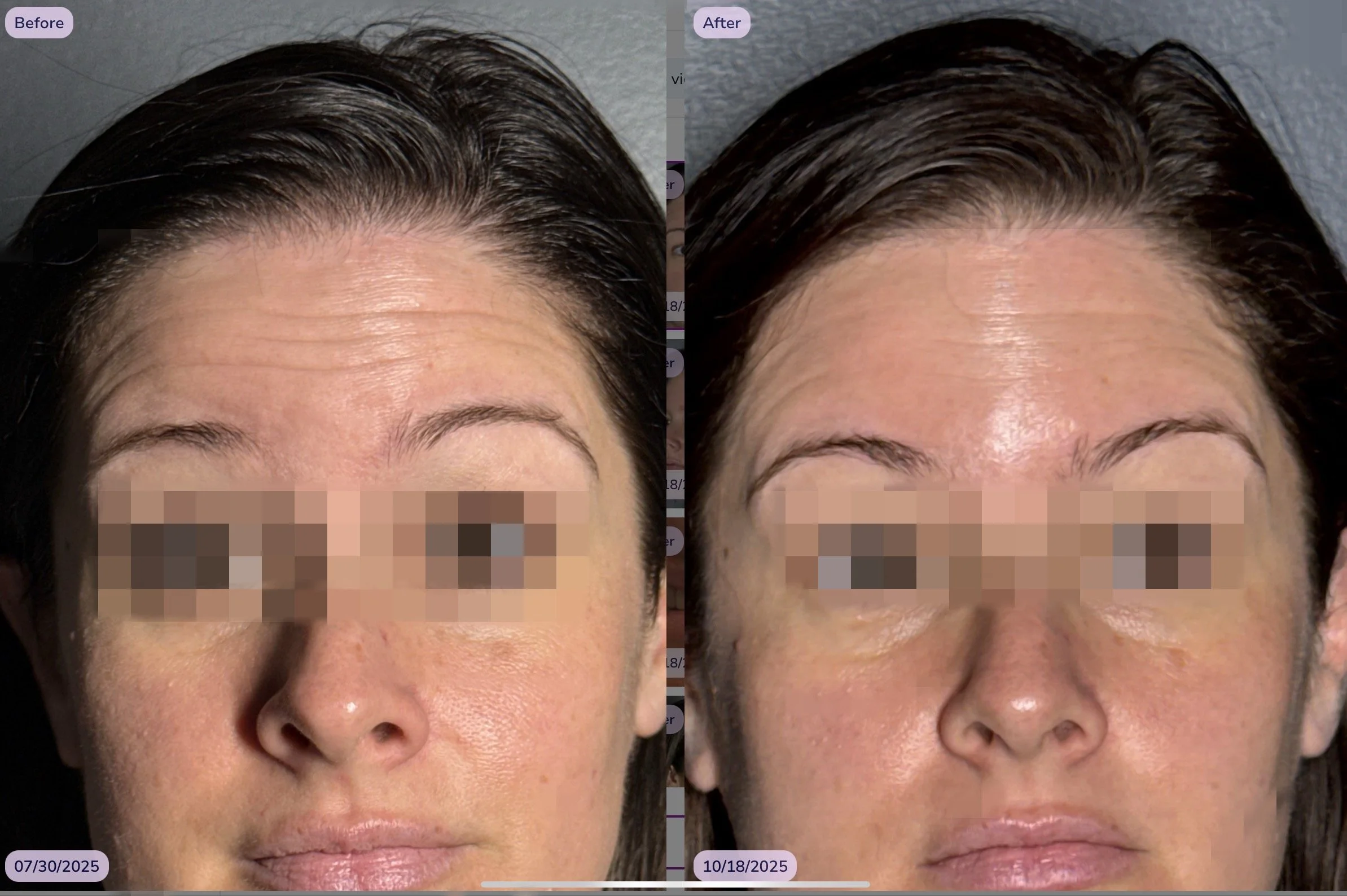 deep lines Frontalis.jpeg