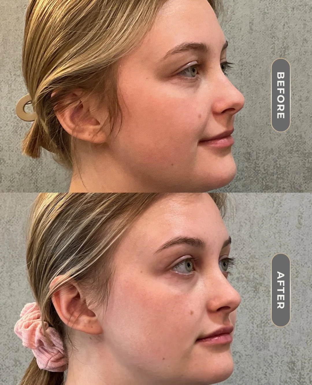 Ever wonder how small, targeted treatments can make such a big difference?

This transformation combines: 
💋 Volbella to naturally enhance the lips 
✨ Kybella to contour and refine the under-chin area

It&rsquo;s not about changing your face, it&rsq