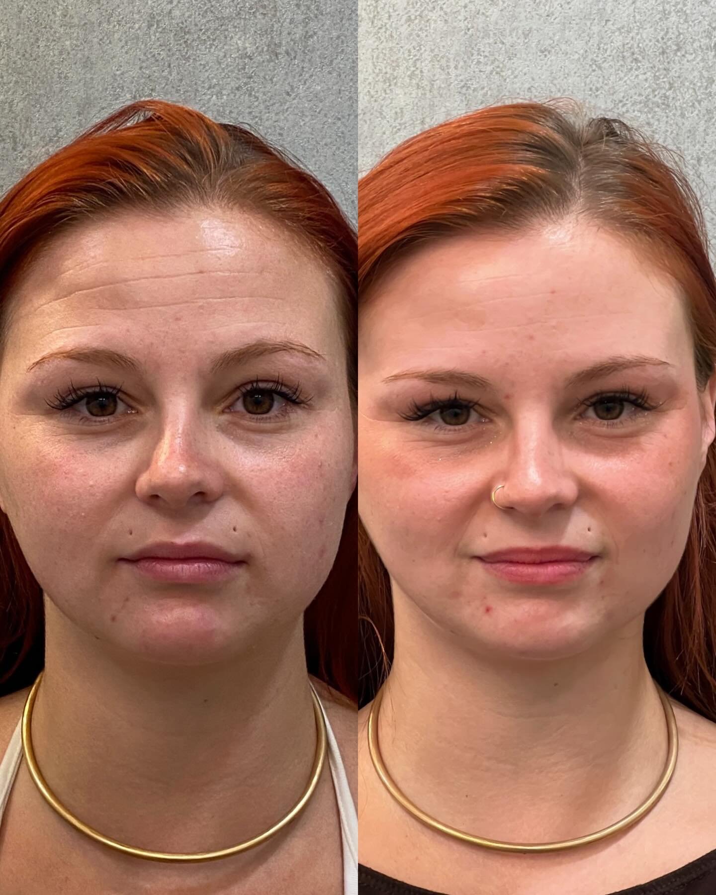 Before and after: thoughtfully placed neuromodulator treatments for natural-looking results ✨ 

Botox and Dysport work by relaxing targeted muscles to soften the appearance of dynamic lines. We&rsquo;re loving this patient&rsquo;s results! 

#therene