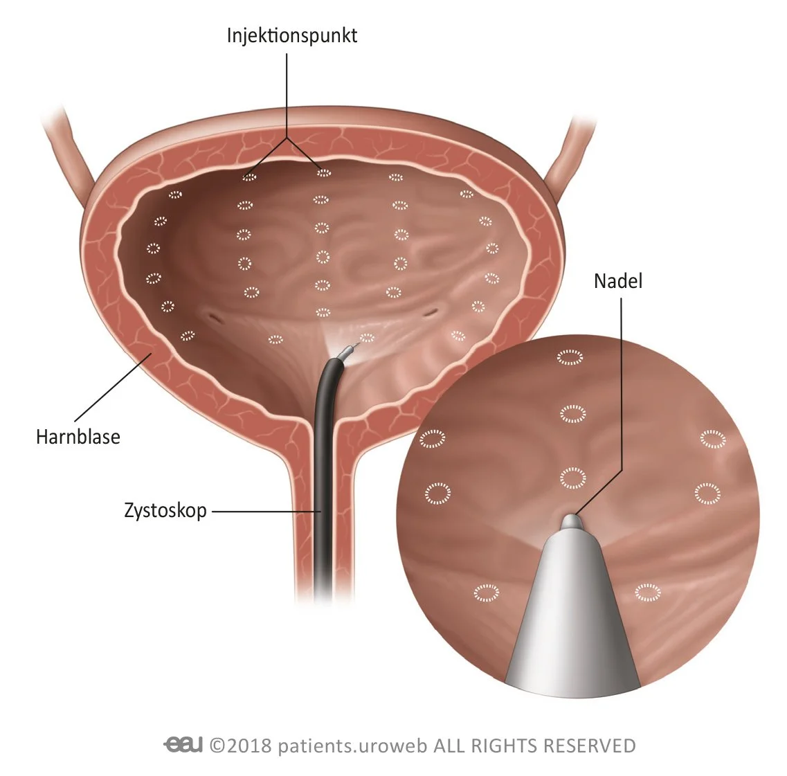 Diagramm der Harnblase mit Zystoskop, Injektionspunkt und Nadel. Beschriftungen zeigen die Position innerhalb der Blase und die Details der Vorgehensweise. Vergrößerung eines Injektionsbereichs.