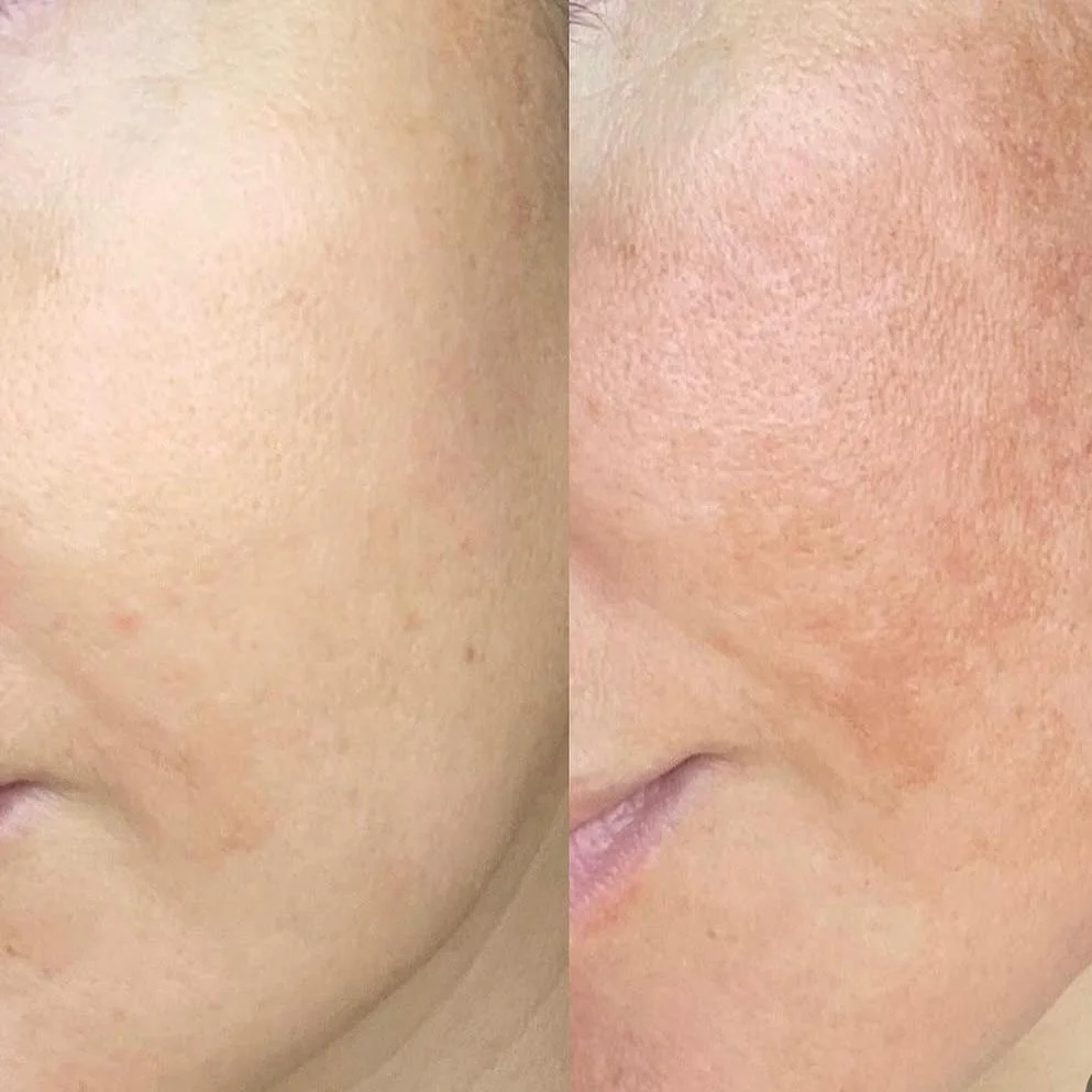 Pigmentacion Tenerife