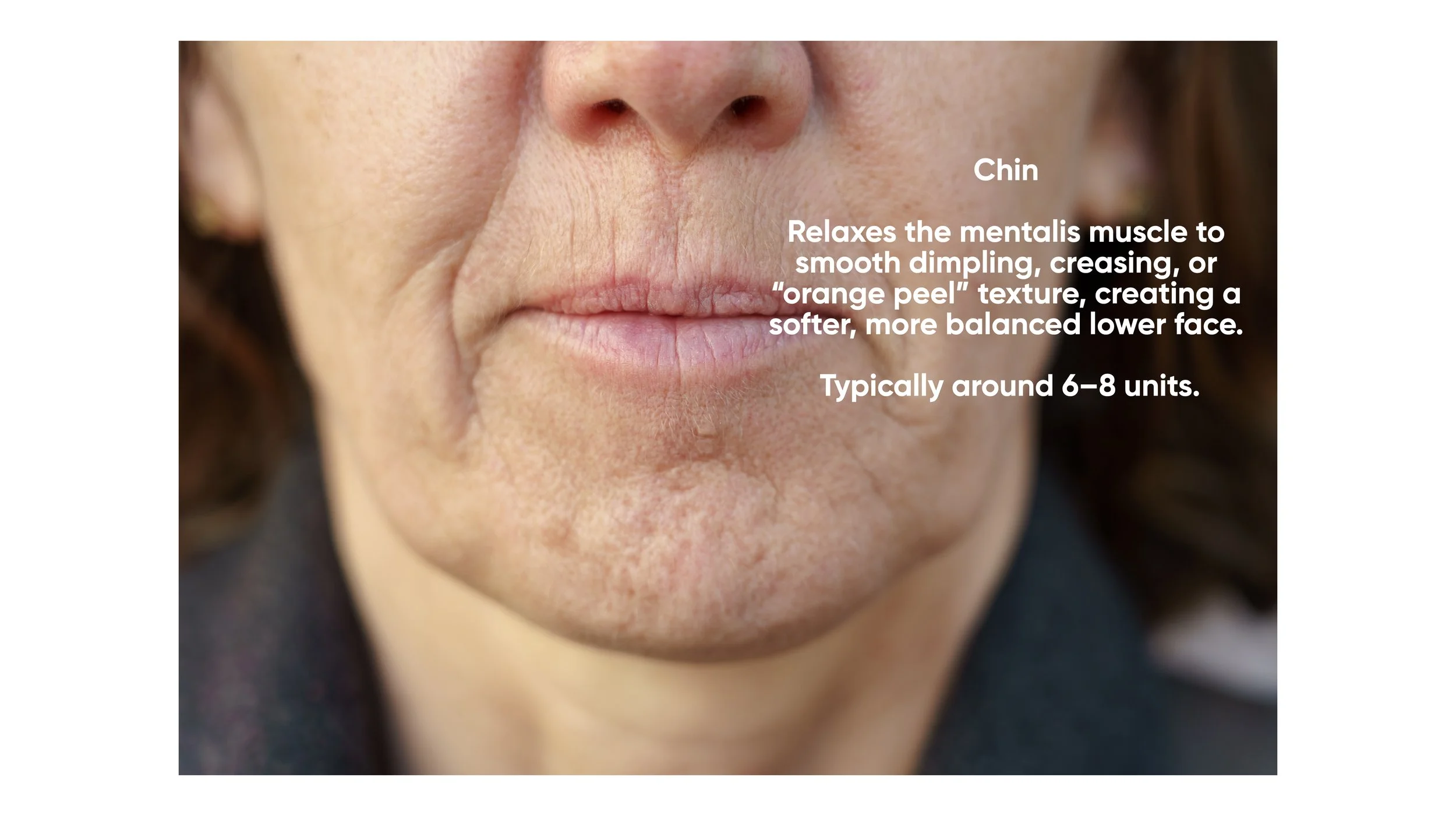 Close-up of a person's lower face, focusing on the chin and lips, with overlaid text explaining the benefits of a skincare treatment for the chin area.