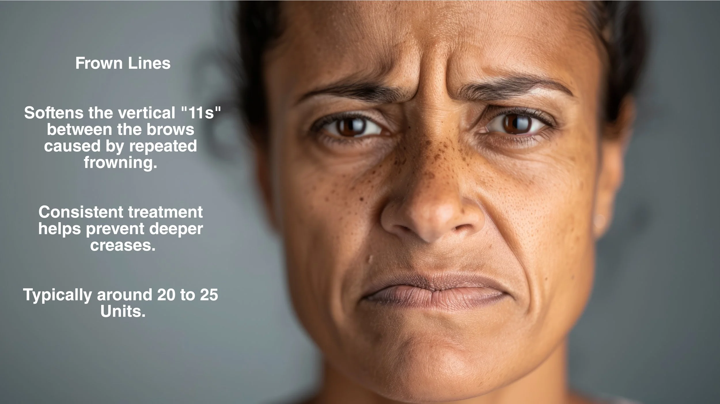 Botox for Frown lines