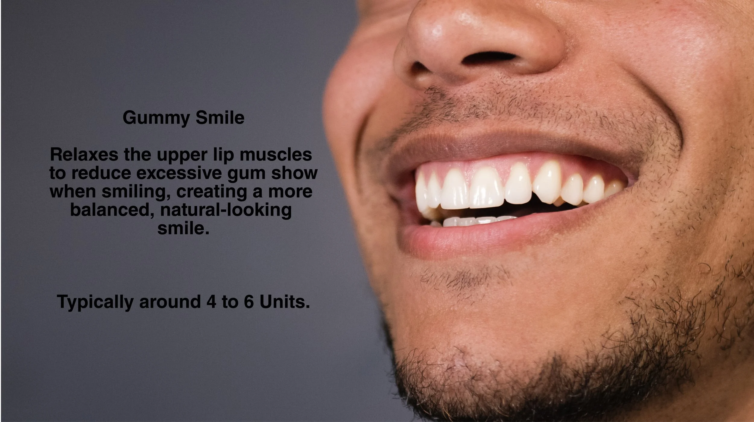 Botox for Gummy Smile