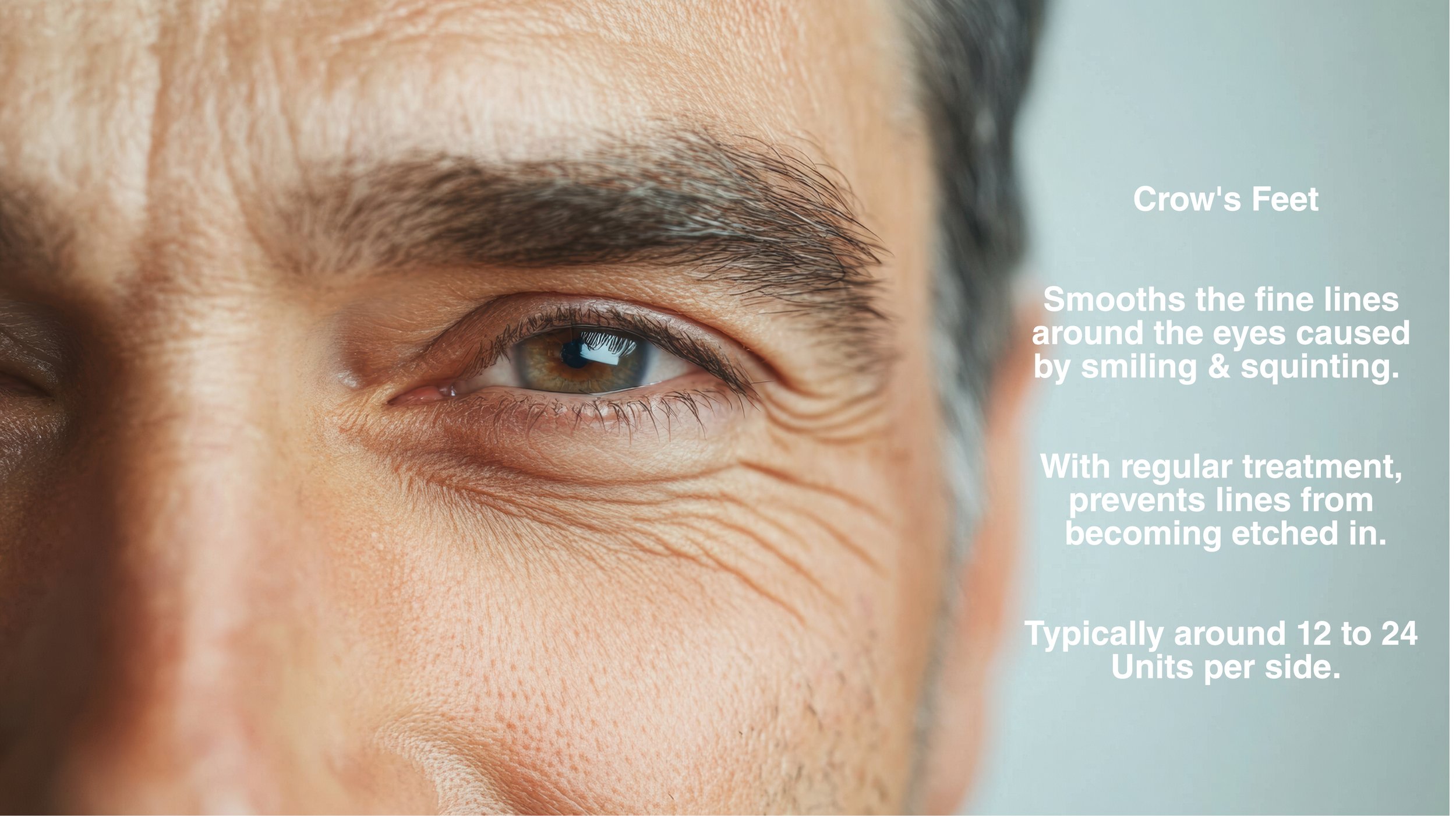 Botox for Crow's Feet