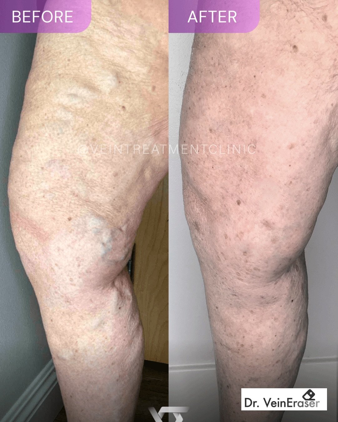 Suffering from throbbing groin pain after pregnancy, especially around your period? 🤔 Those varicose veins might be the culprit!

PSA: That pain ISN&rsquo;T your new normal! You deserve to feel good again. ❤️

Vein Treatment can bring real relief, l