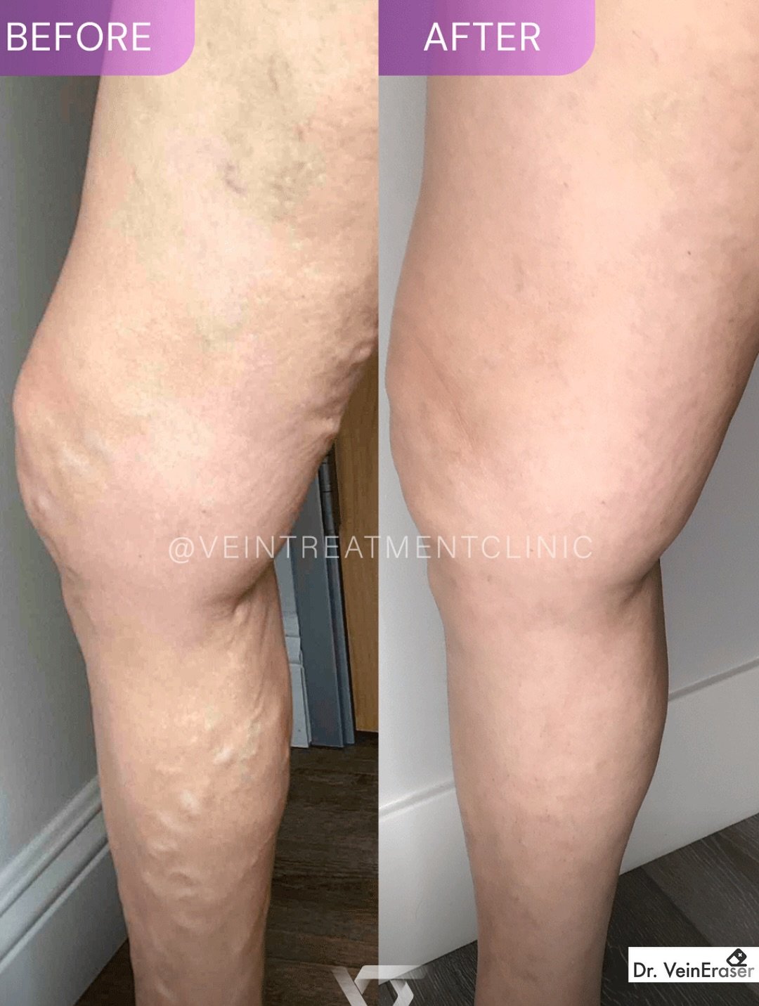 Tired of troublesome varicose veins? 👋

Endovenous Laser Treatment (EVLT) and Radiofrequency Ablation (RFA) might be your solution! Both are minimally invasive procedures that use thermal (heat) energy to gently close off problem veins like the Grea