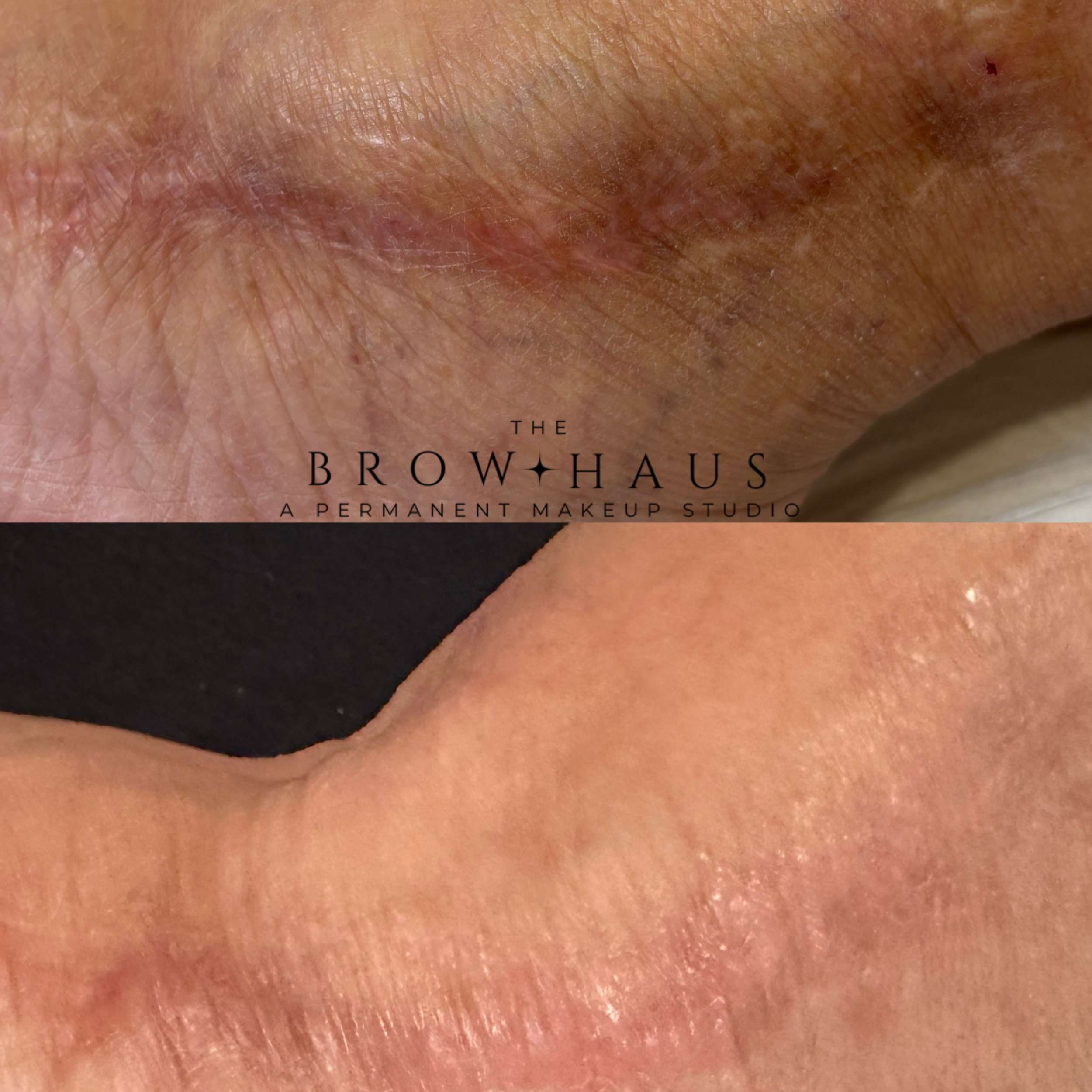 before and after image of women ankle with large scar. before image is before scar Revision and after scar Revision showing change from the treatment