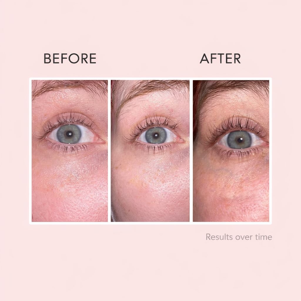Real results don&rsquo;t happen overnight ✨

Lash growth is a cycle &mdash; and this is exactly why Lashlab works so well.
✔️ Stronger lashes
✔️ Longer lashes
✔️ Healthier growth over time

Consistency is key. Stick with it and trust the process 🤍

