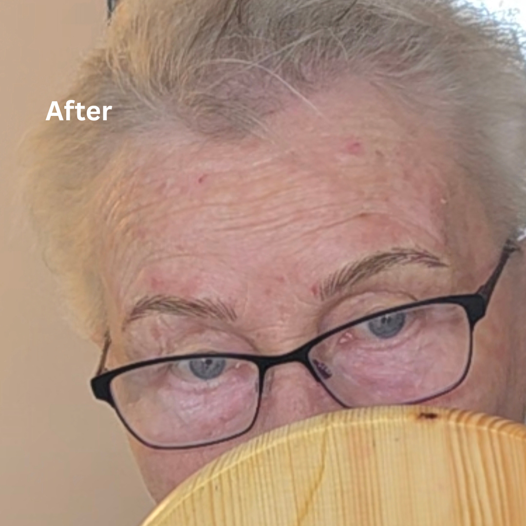 Hairstokes on mature skin right after semi-permanent makeup treatment  in Bristol