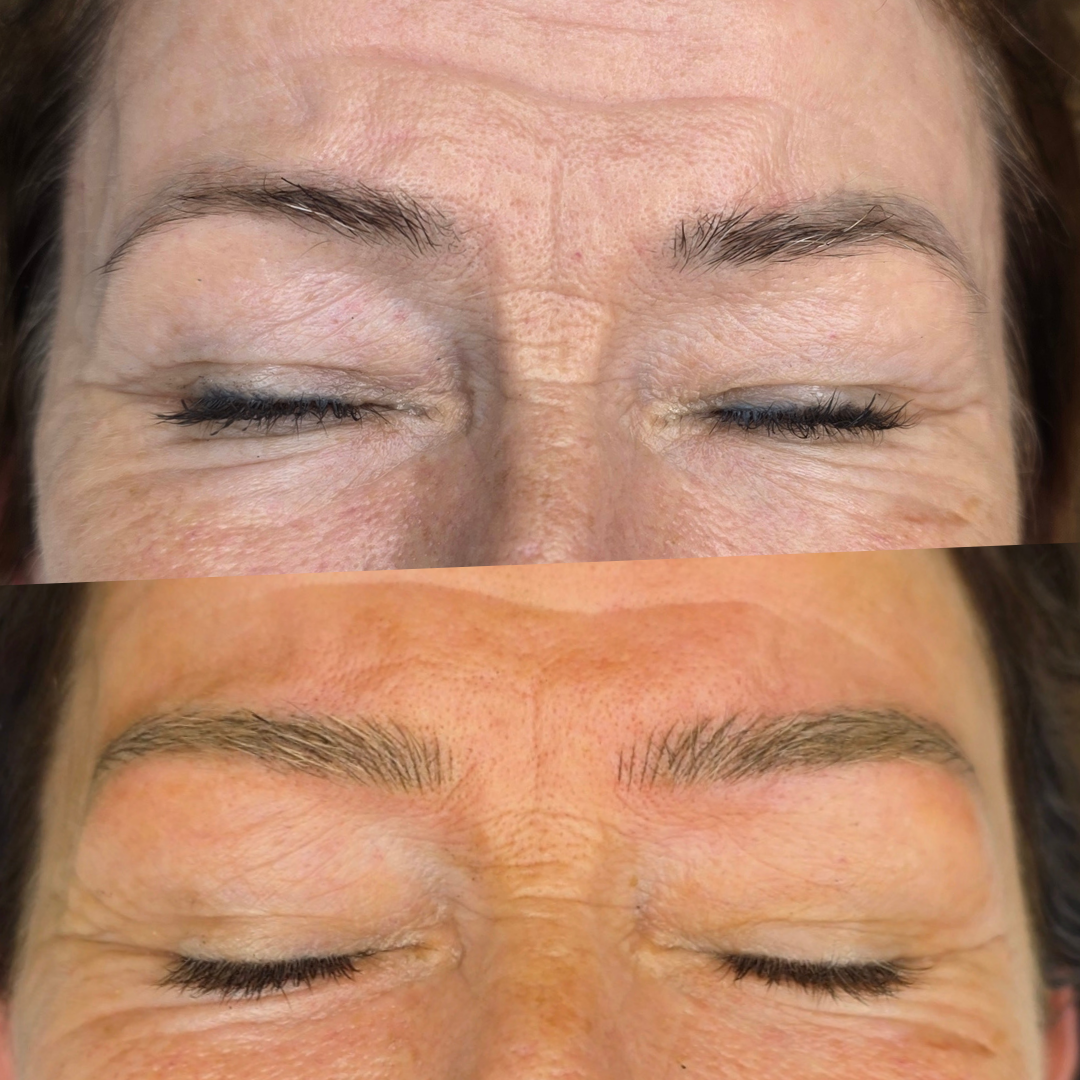 Before and after hairstroke brows transformation on mature skin whose had old microblading brows done from several years ago. 
