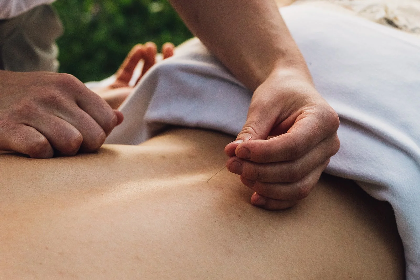 Person giving acupuncture treatment on a person's back outdoors.