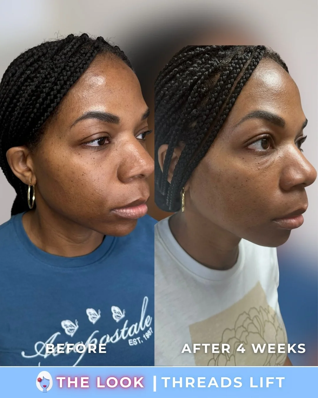 Side-by-side comparison of a woman before and after four weeks of threads lift, showing facial skin improvement, with noticeable reduction in wrinkles and sagging.