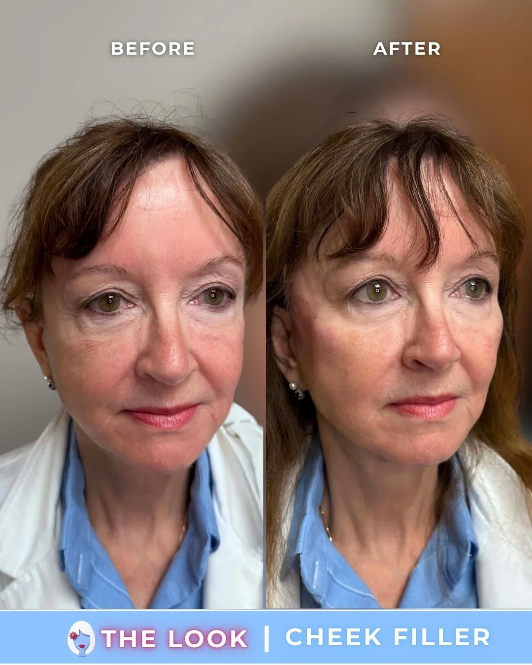 the look medical aesthetics filler before and afters (2).jpg