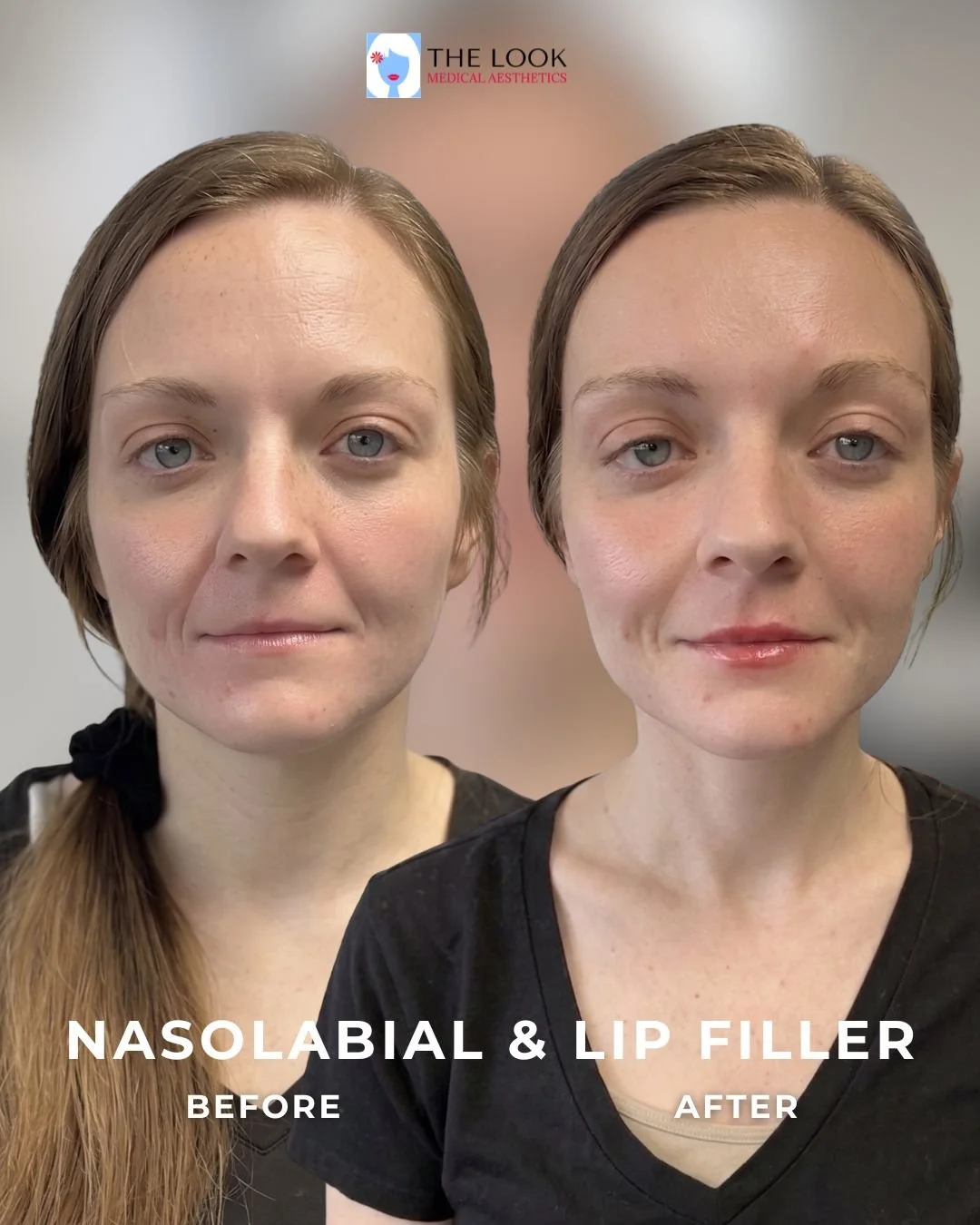 Before and after photos of Lip and dermal (laugh lines) filler in Carmel, IN at The Look Medical Aesthetics,  a top-rated med spa just North of Indianapolis, IN