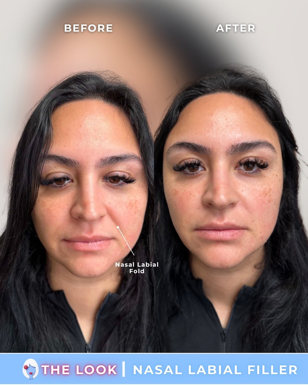 the look medical aesthetics filler before and afters (4).jpg