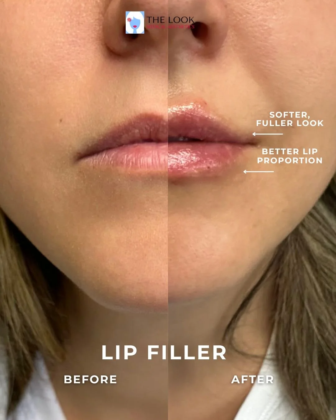 Before and after photos of Lip filler in Carmel, IN at The Look Medical Aesthetics,  a top-rated med spa just North of Indianapolis, IN