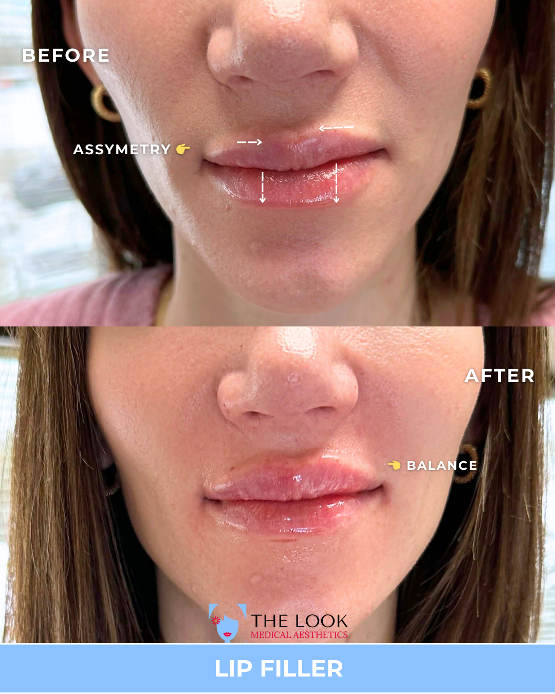 Before and after images of a woman's lips showing the results of lip filler injection, with annotations pointing out asymmetry in the before image and balance in the after image, with a logo for The Look Medical Aesthetics.