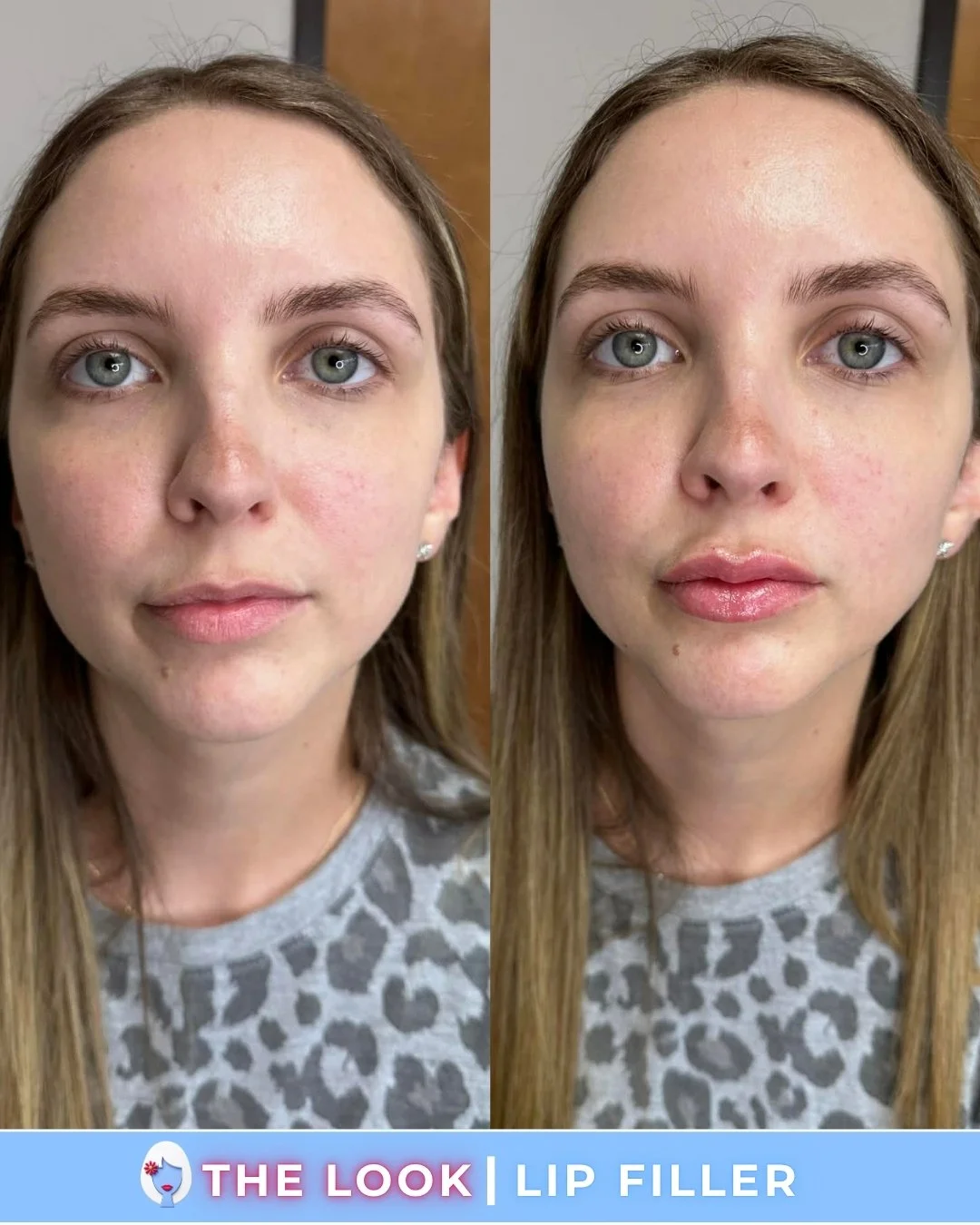 Before and after comparison of a woman's face showing the effects of lip filler treatment. The left side displays her natural lips, and the right side shows her with fuller lips after treatment.
