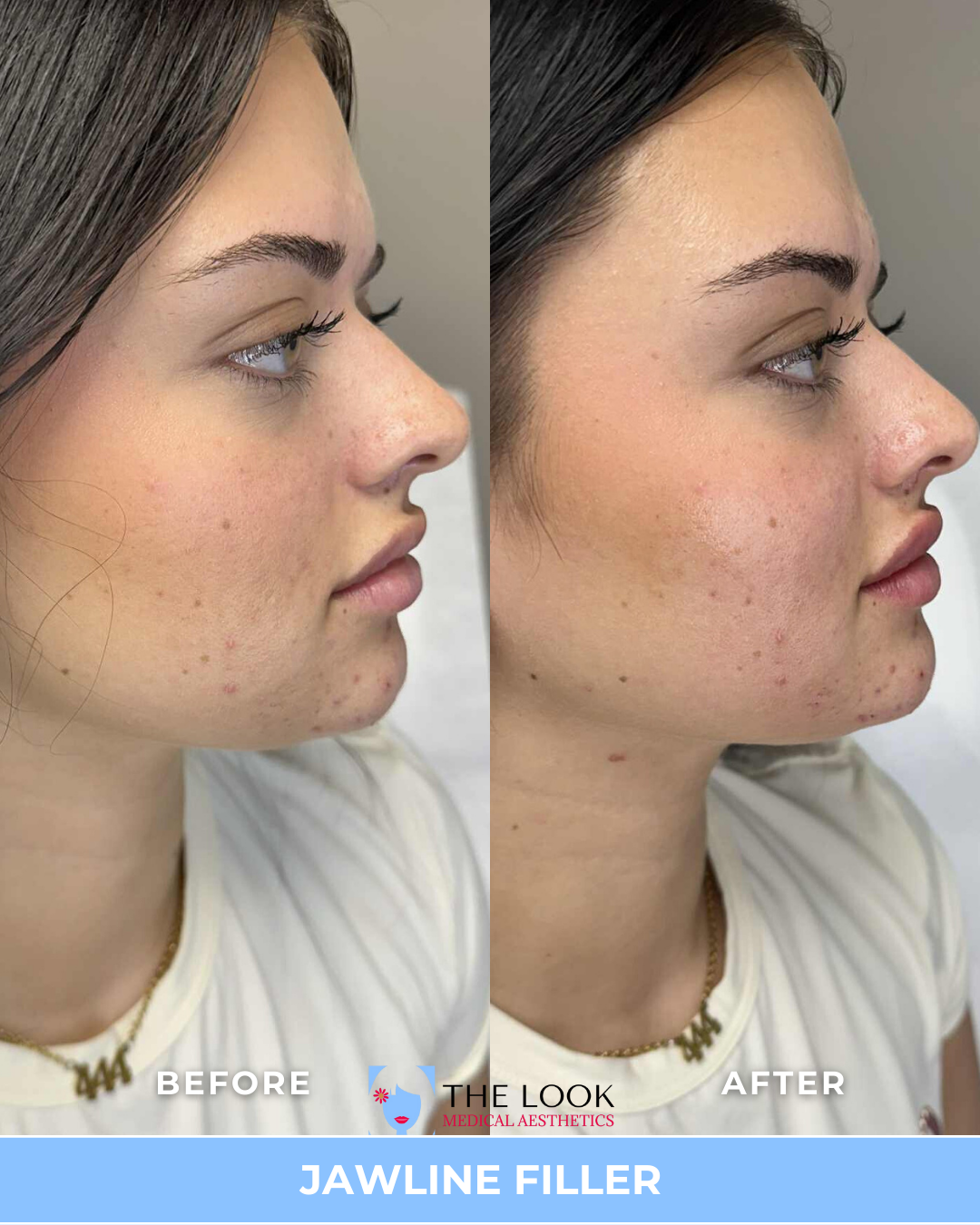 Side-by-side comparison of a woman's face before and after jawline filler treatment, showing a more defined jawline in the after photo.