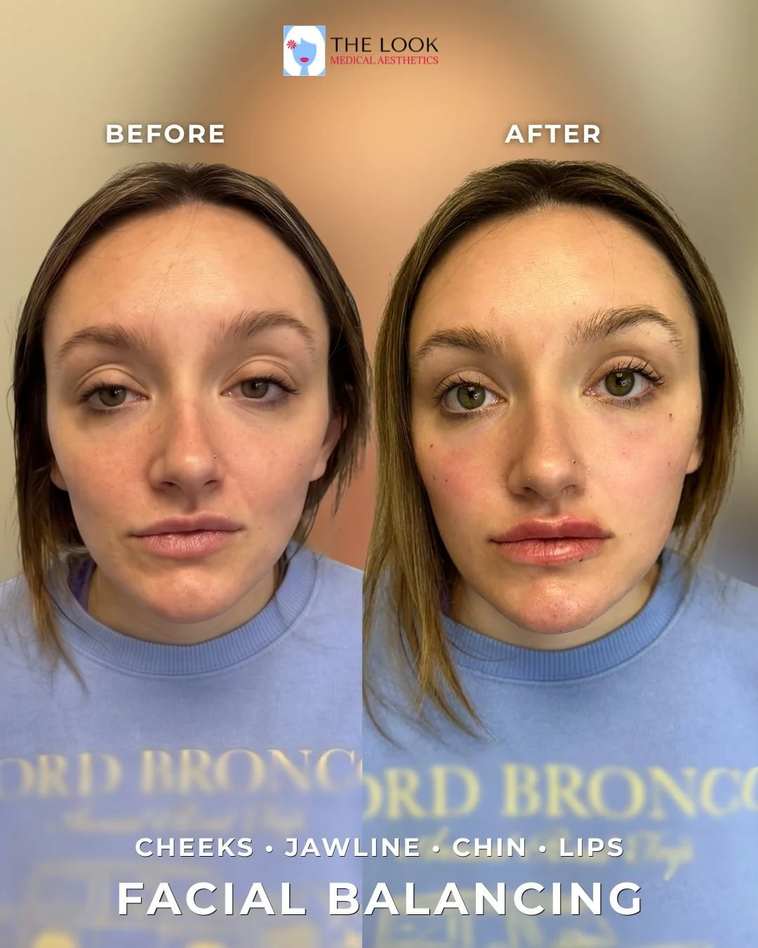 Before and after photos of facial balancing and dermal filler treatment in Carmel, IN at The Look Medical Aesthetics,  a top-rated med spa just North of Indianapolis, IN in downtown Carmel, Indiana.  