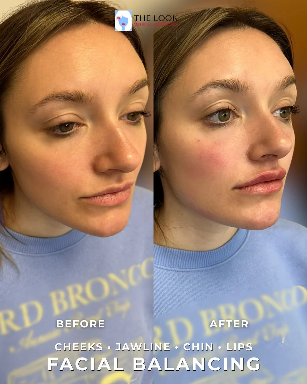 Facial balancing before and after:  jaw, cheek, chin, lip filler at The Look Medical Aesthetics, a Med Spa in Carmel, IN.  