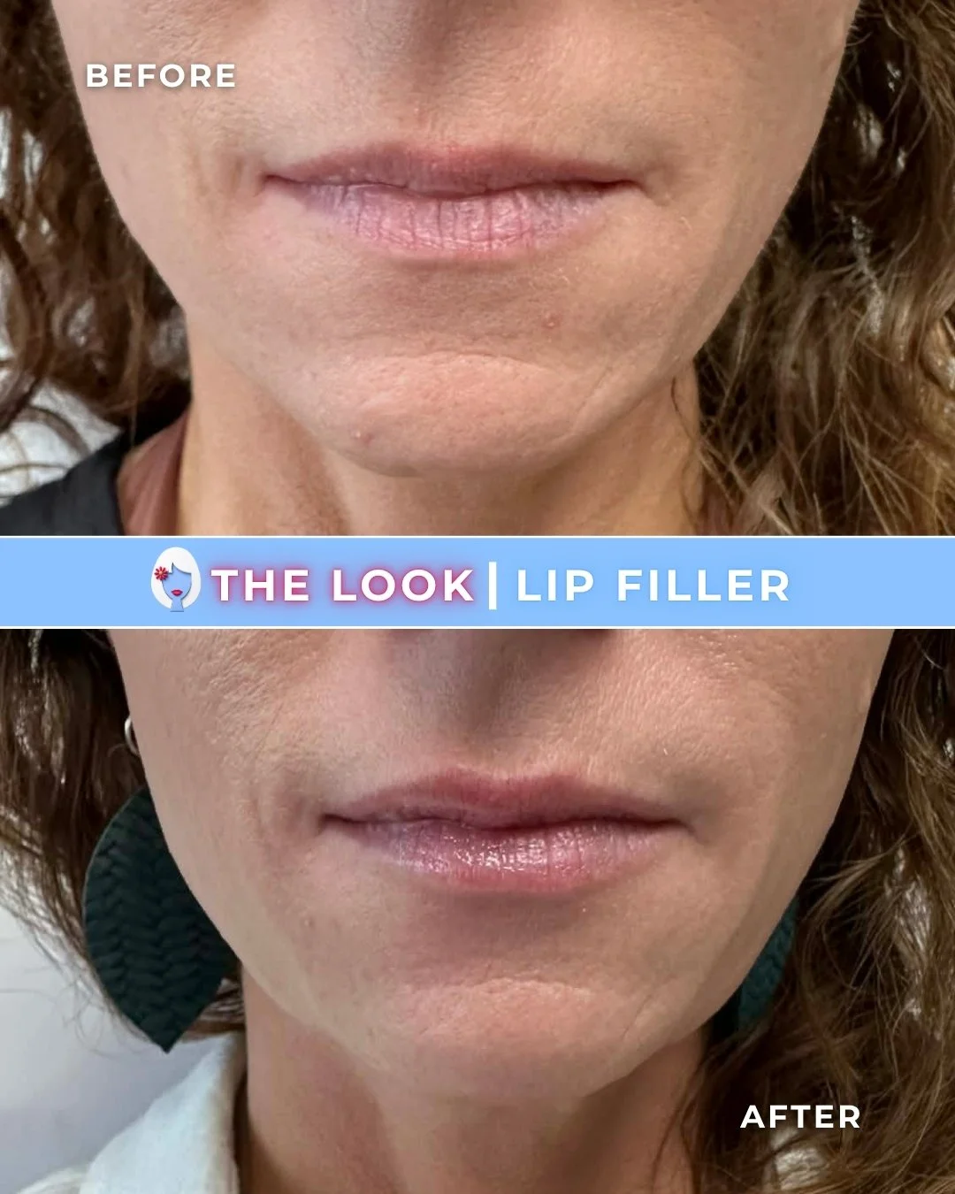 Comparison of lips before and after lip filler treatment, showing fuller lips after the procedure.