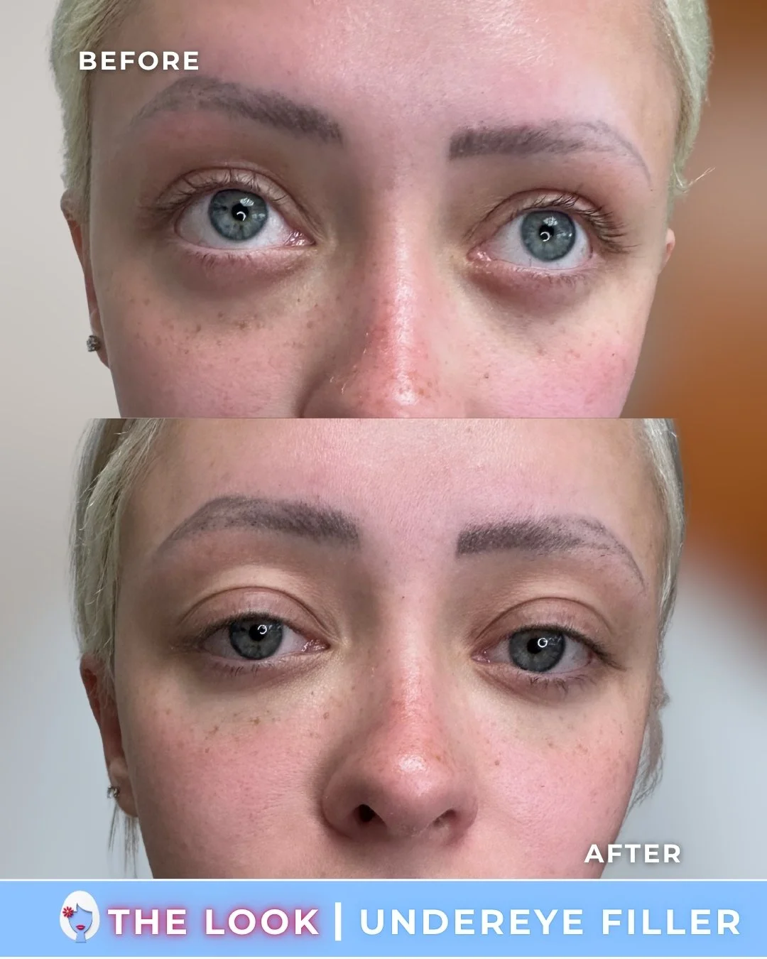 the look medical aesthetics filler before and afters (7).jpg