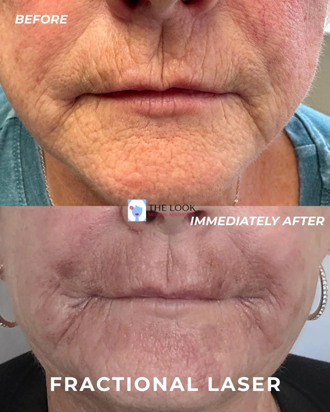Before and after photos of CO2 laser peel in Carmel, IN at The Look Medical Aesthetics,  a top-rated med spa just North of Indianapolis, IN