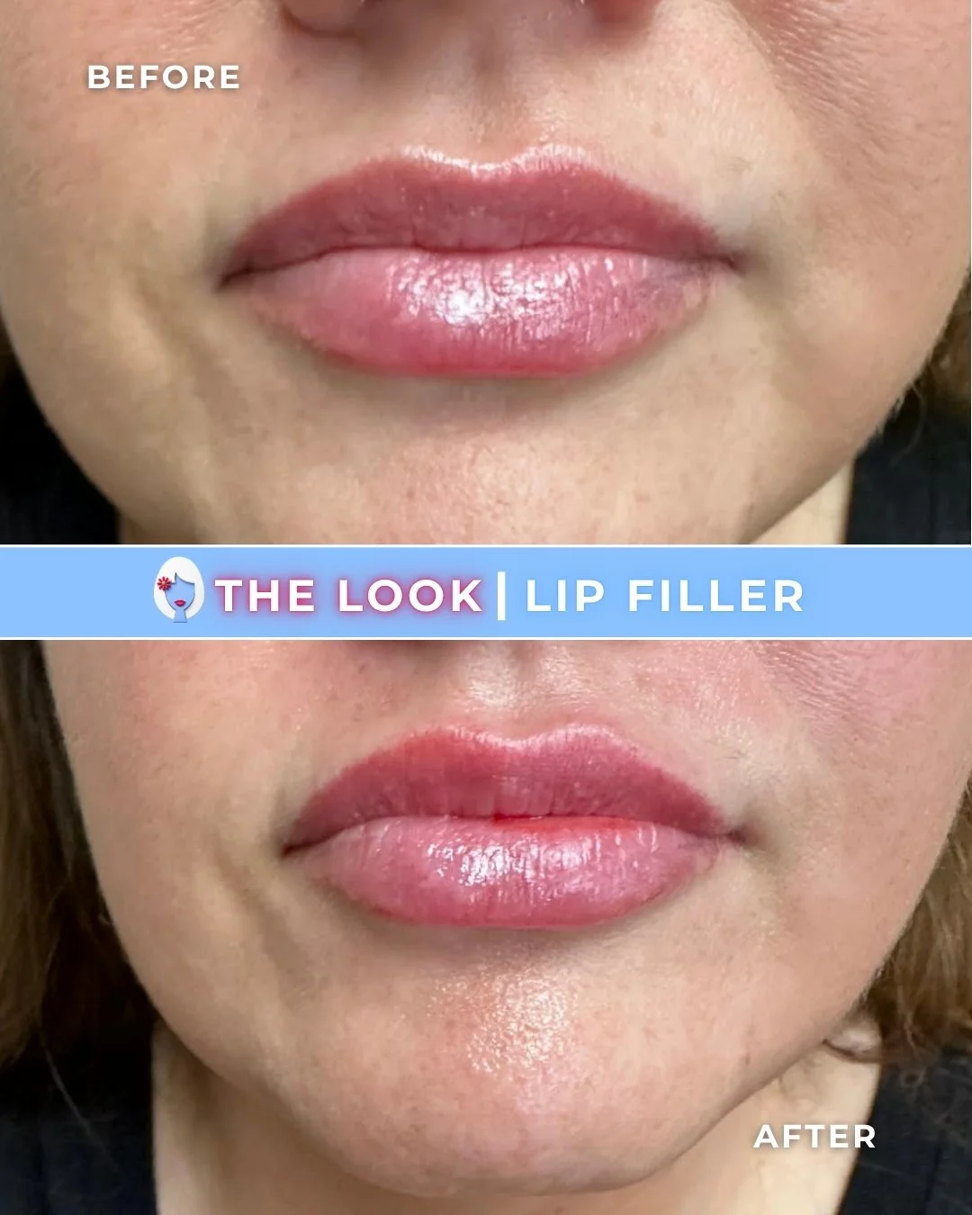 Before and after images of lips showing the effects of lip filler, with the words "BEFORE" in the top left corner of the first image and "AFTER" in the bottom right corner of the second image. A blue banner in the middle reads "THE LOOK | LIP FILLER"