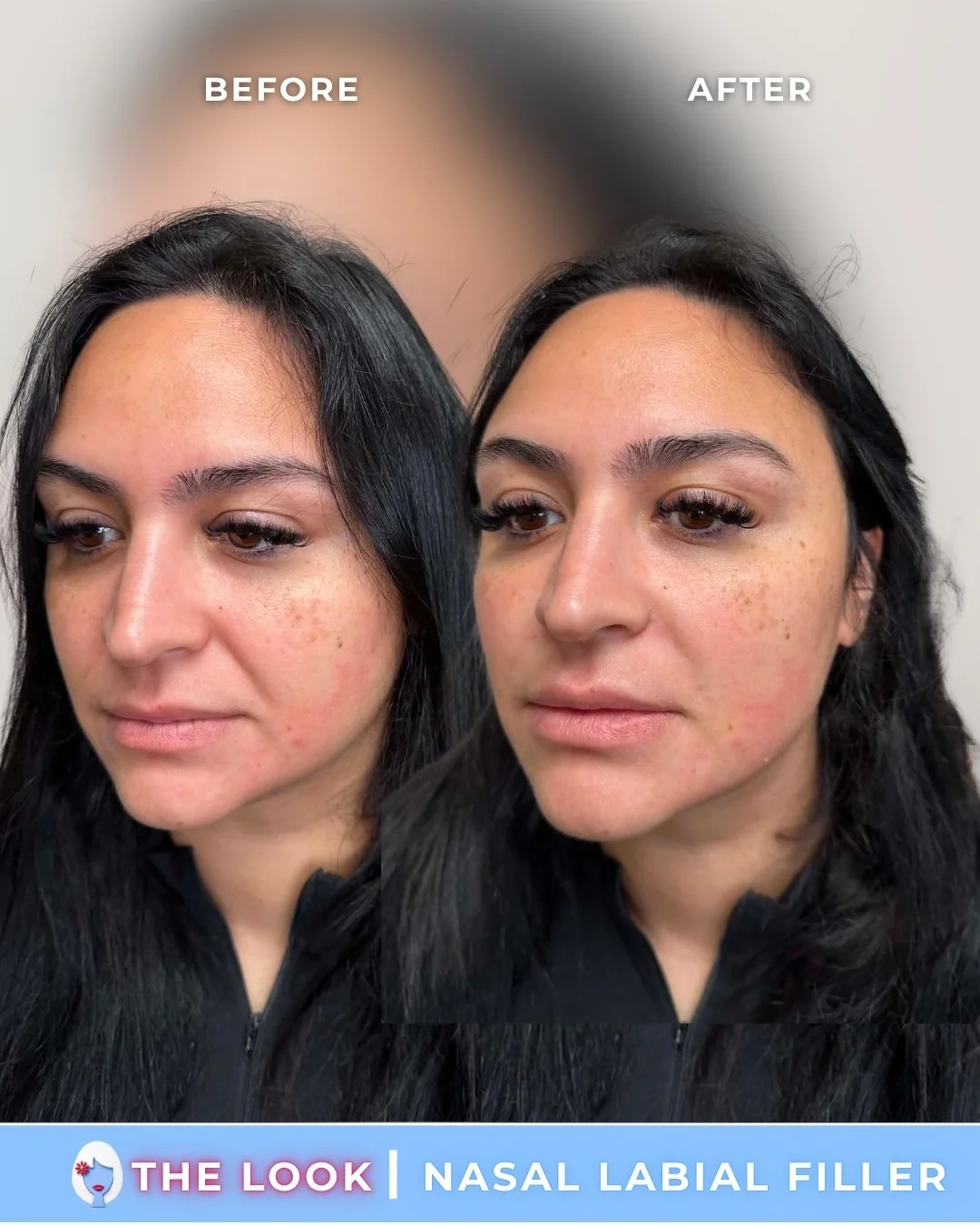 the look medical aesthetics filler before and afters (5).jpg
