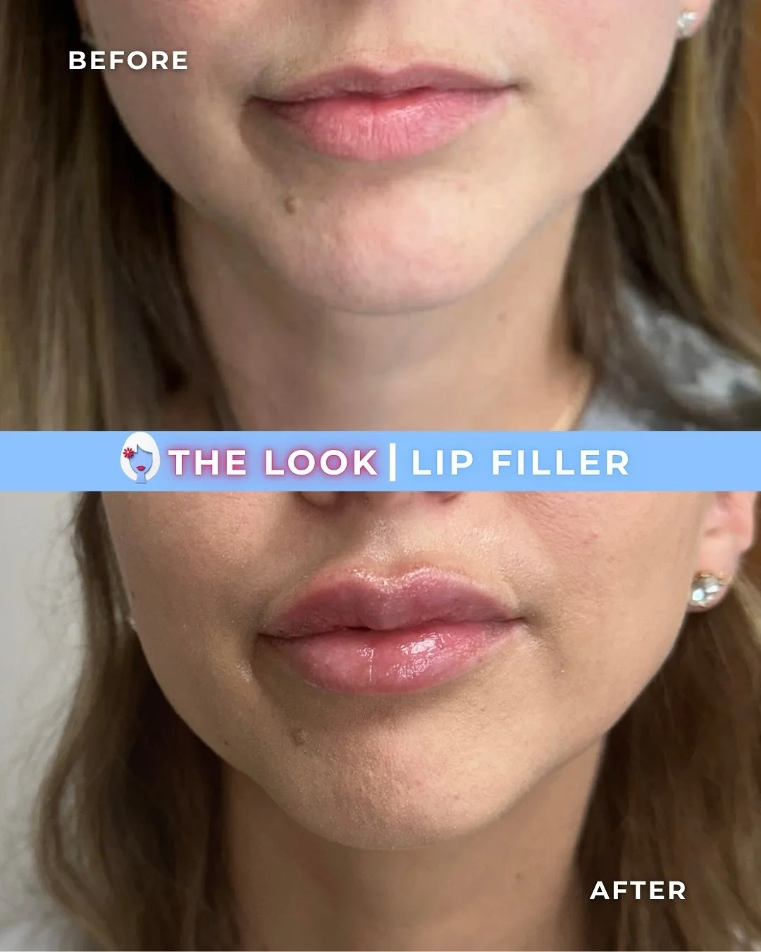 Side-by-side comparison of lips before and after lip filler treatment, with the 'before' image showing natural lips and the 'after' image showing fuller, glossy lips.