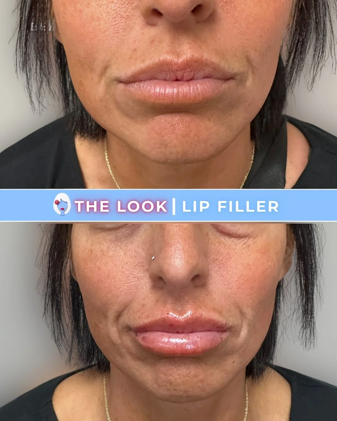 Comparison photos showing the results of lip filler on a woman, with the before image above and the after image below. The after image features fuller, more defined lips with a glossy appearance.