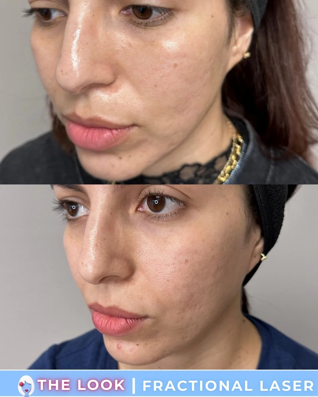 Before and after images showing skin improvement after fractional laser treatment, with smoother skin texture and reduced blemishes.