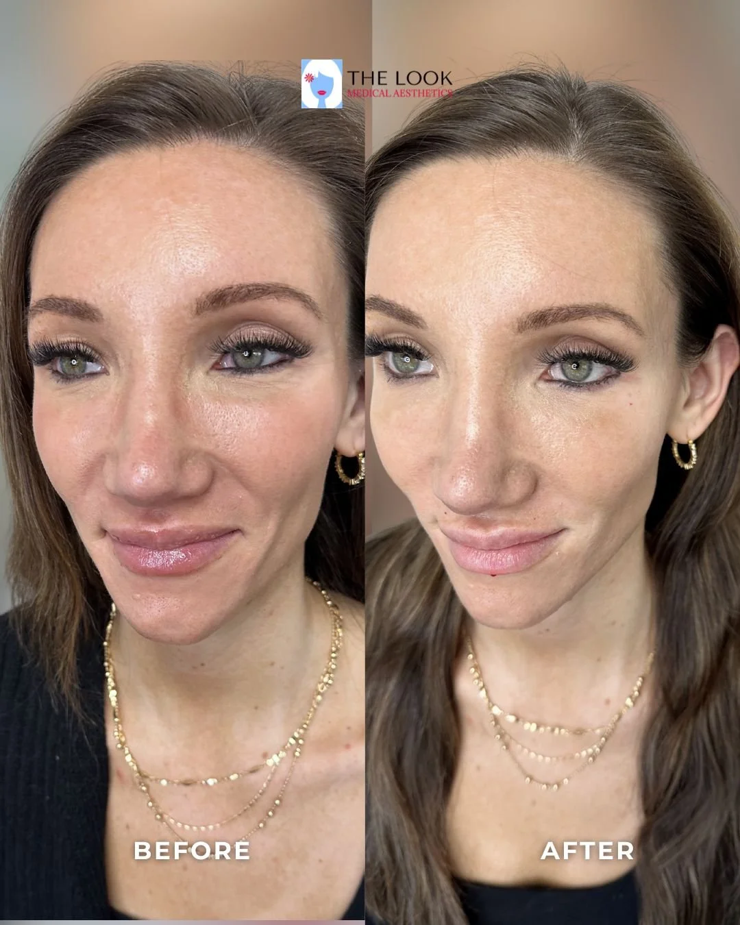 The Look Medical Spa is a leading provider of advanced dermal filler procedures including temple filler in Carmel, Indiana!