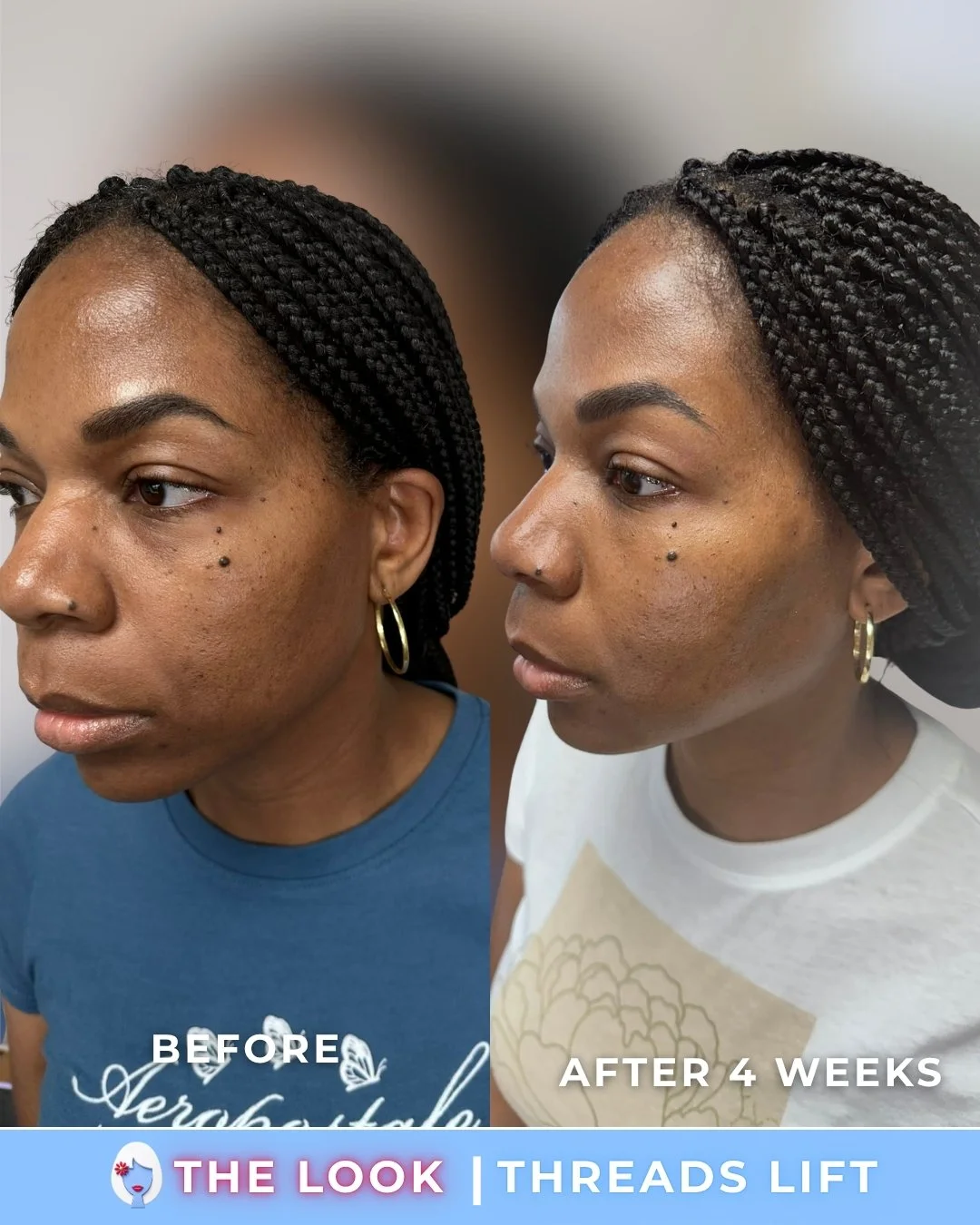 Comparison of a woman's face before and after 4 weeks of threads lift treatment, showing improved skin tightness and lifting in the after photo.