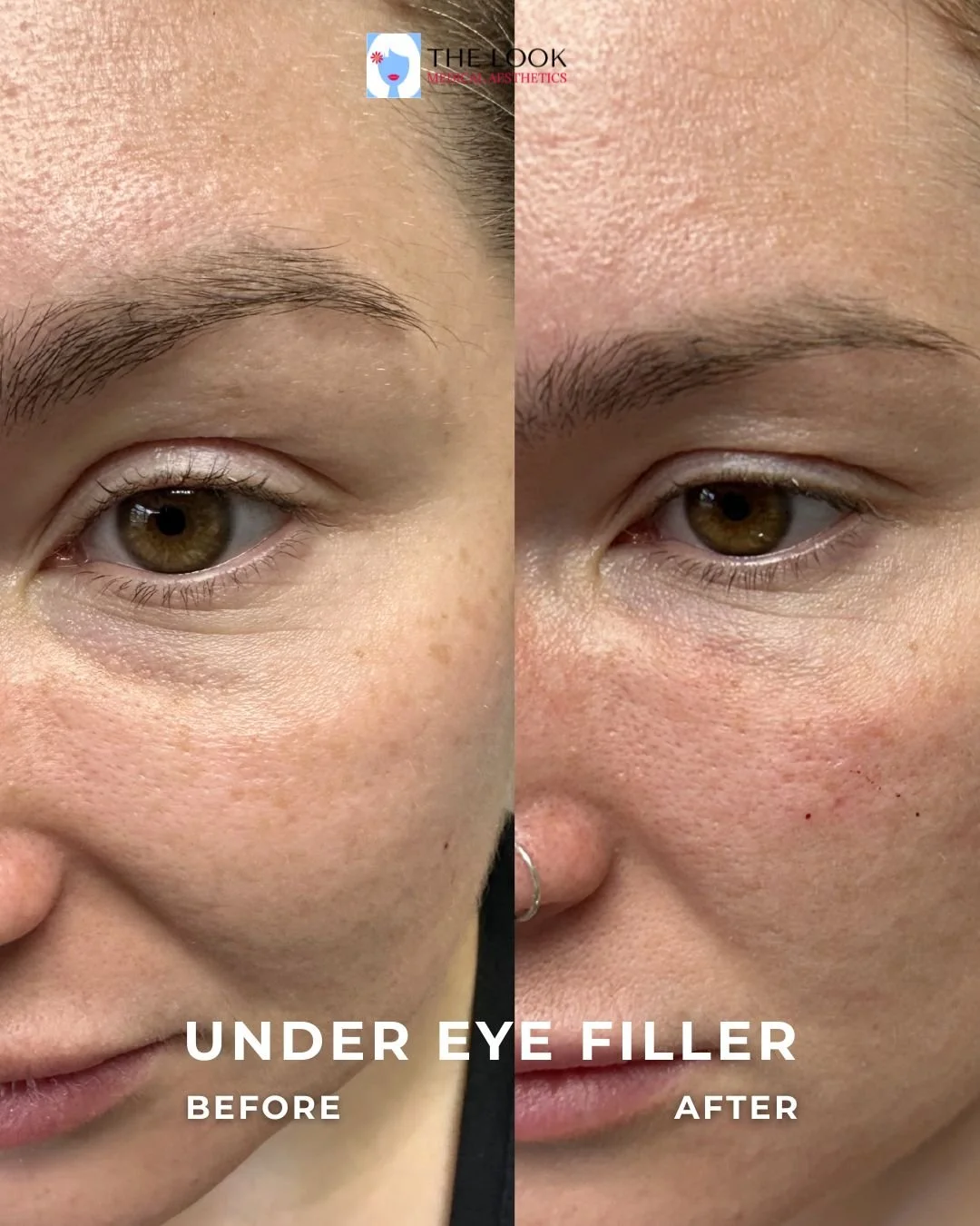 the look medical aesthetics before and after (9).jpg