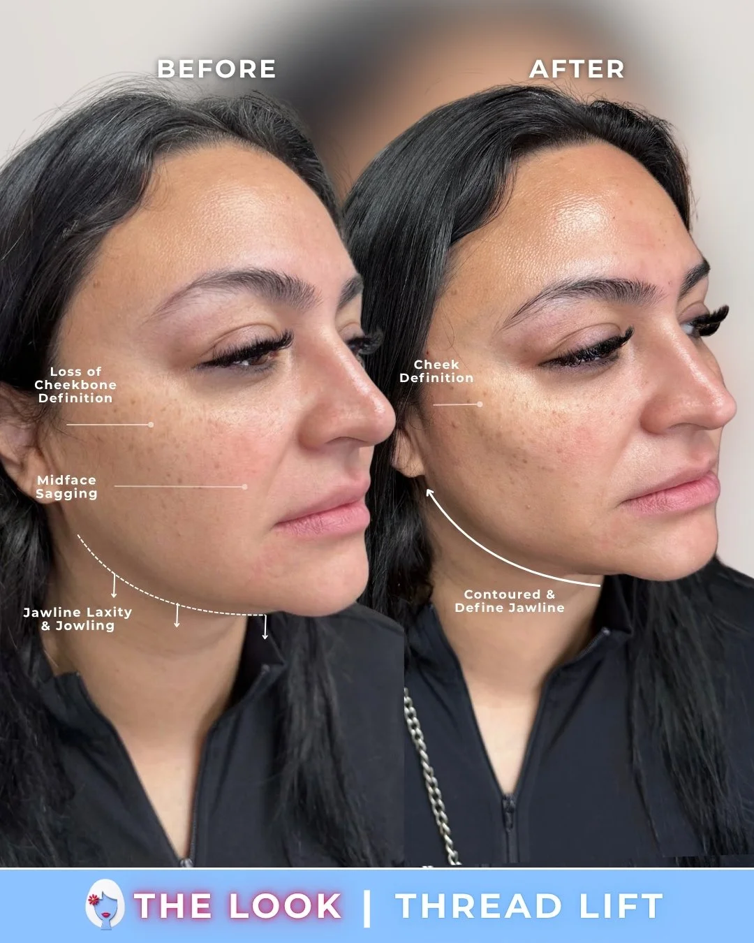 the look medical aesthetics filler before and afters (8).jpg