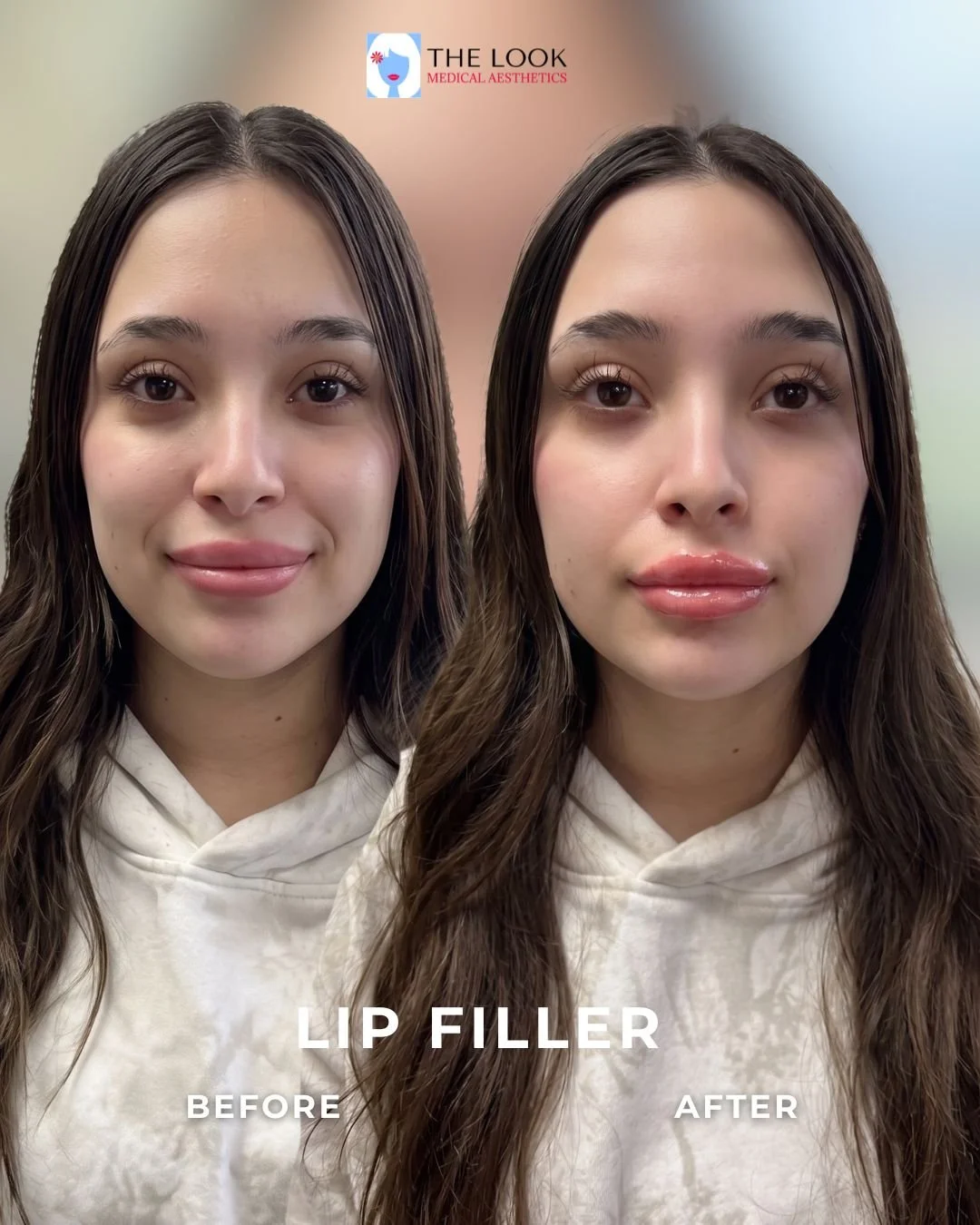 Before and after photos of lip filler treatment in Carmel, IN at The Look Medical Aesthetics,  a top-rated med spa just North of Indianapolis, IN in downtown Carmel, Indiana.  