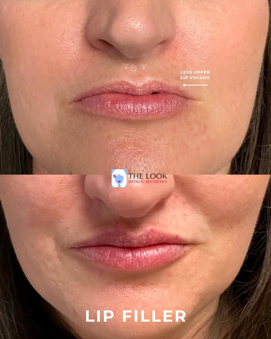 Natural lip filler and lip injection enhancement | Before & After Photo at The Look Medical Spa in Carmel, IN 46032 