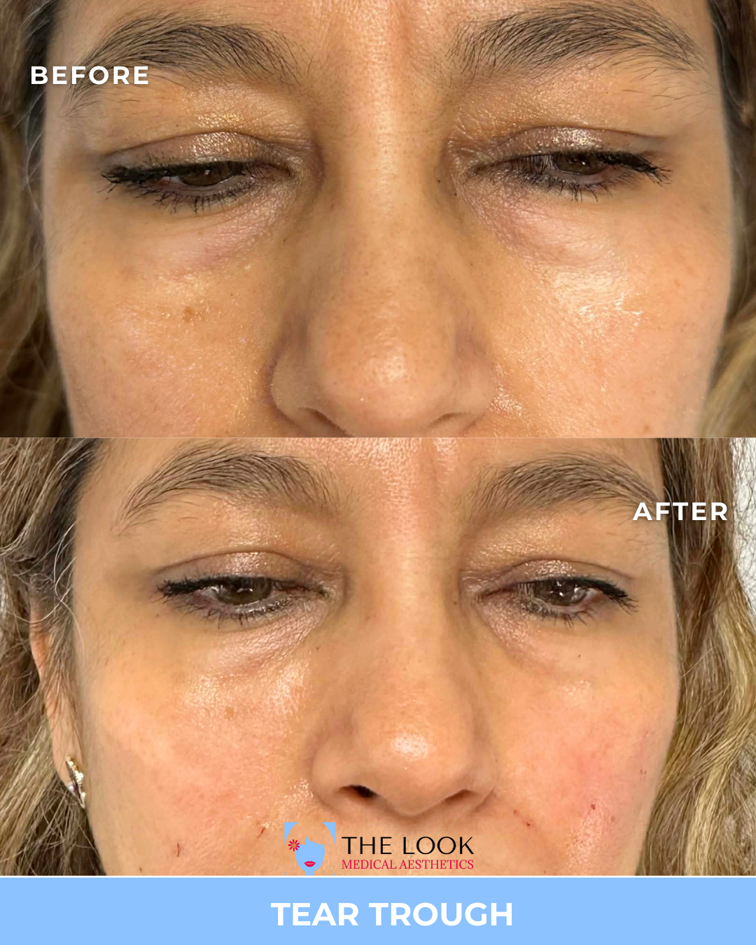 Before and after photos showing the reduction of tear trough hollows and under-eye bags in a woman's face, indicating a cosmetic procedure for under-eye rejuvenation.