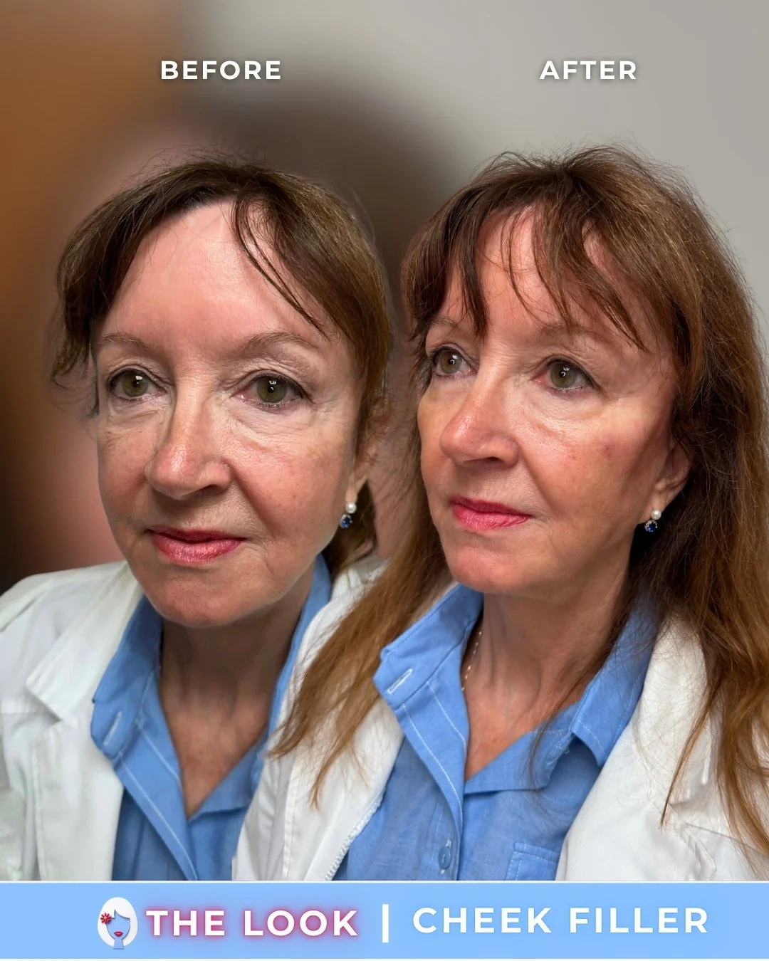 the look medical aesthetics filler before and afters (3).jpg