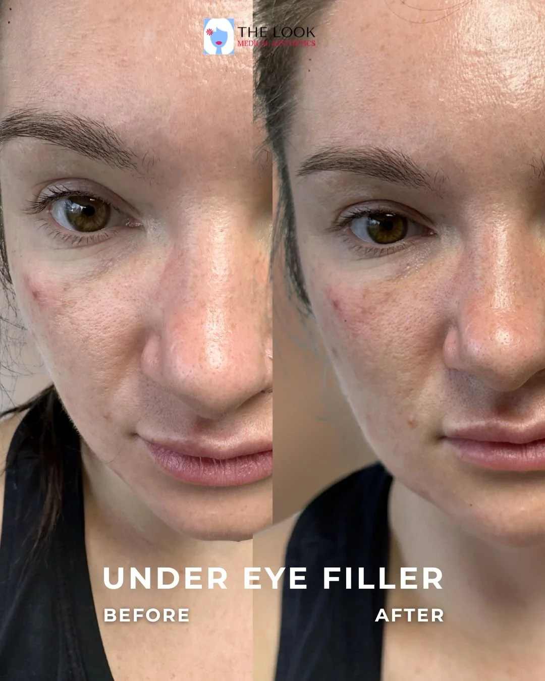Before and after photos under eye and tear trough dermal filler treatment in Carmel, IN at The Look Medical Aesthetics,  a top-rated med spa just North of Indianapolis, IN in downtown Carmel, Indiana.  